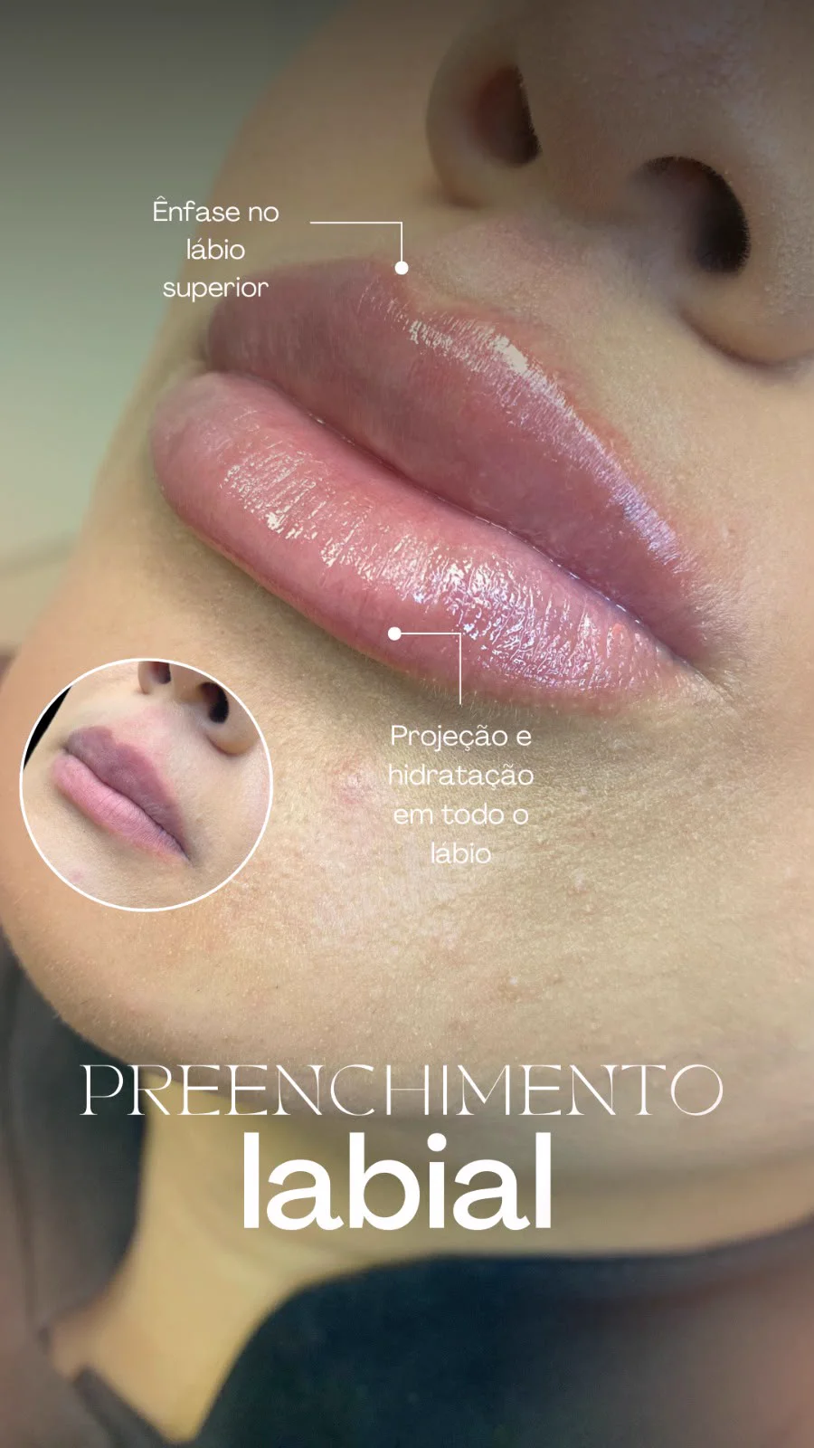 Harmonização facial